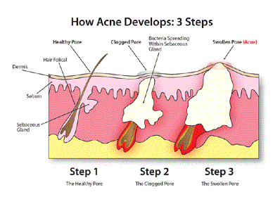 How Acne Developes: 3 Steps by Dr. David MacKoul